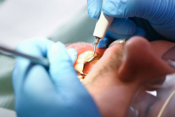 Best Emergency Dental Extractions in North Miami, FL
