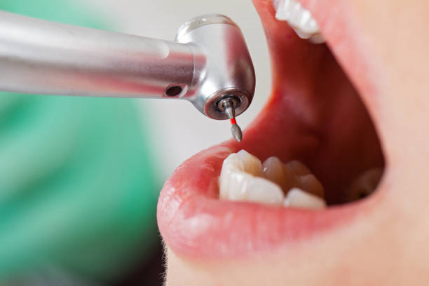 Best Emergency Dentist for Knocked-Out Tooth in North Miami, FL